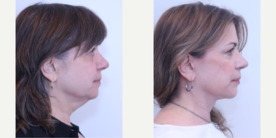 Facelift before and after photo