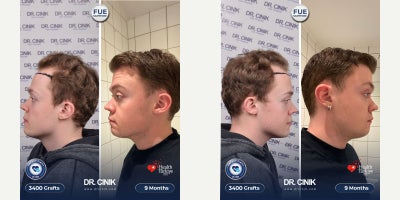 Hair Loss Treatment before and after photo