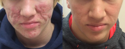 Accutane before and after photo
