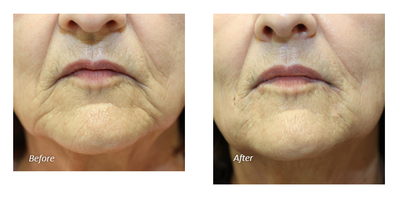 Botox before and after photo