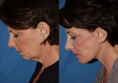 Brow Lift before and after photo