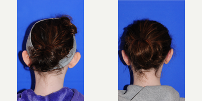 Ear Surgery before and after photo