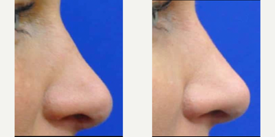 Revision Rhinoplasty before and after photo