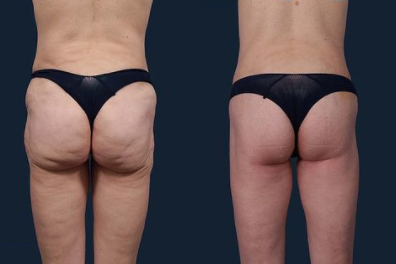 Body Lift before and after photo