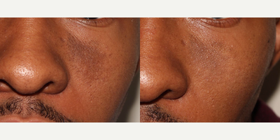 GentleLase before and after photo