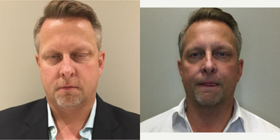 Kybella before and after photo