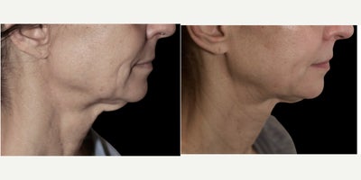 Morpheus8 before and after photo