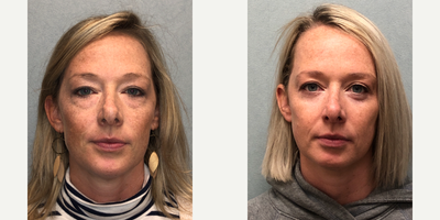 Brow Lift before and after photo