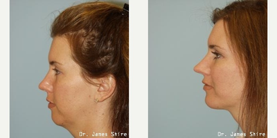 Chin Implant before and after photo