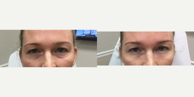 Dermal Fillers before and after photo