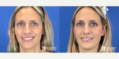 Dermal Fillers before and after photo