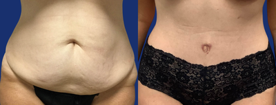 Tummy Tuck before and after photo