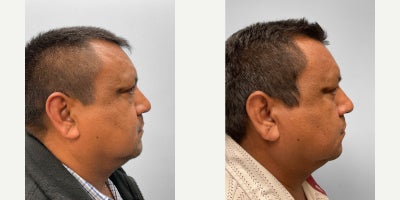 Eyelid Surgery before and after photo