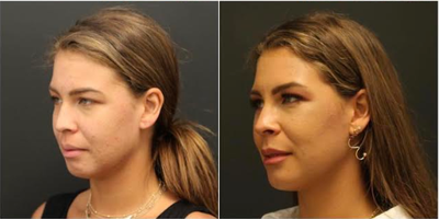 Lip Fillers before and after photo