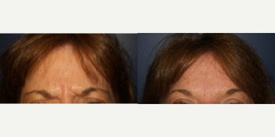 Botox before and after photo