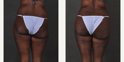 Brazilian Butt Lift before and after photo