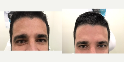 Microneedling before and after photo