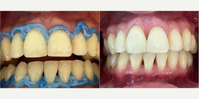 Teeth Whitening before and after photo