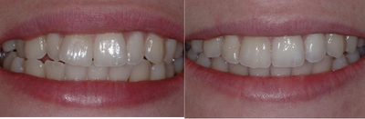Invisalign before and after photo