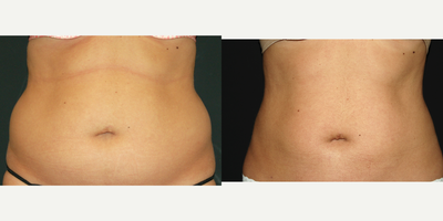 Liposculpture before and after photo