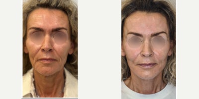 Lower Facelift before and after photo
