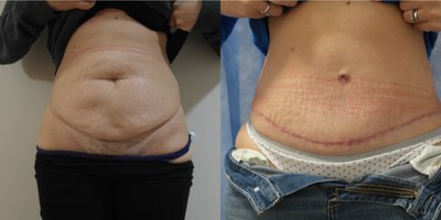 Tummy Tuck before and after photo