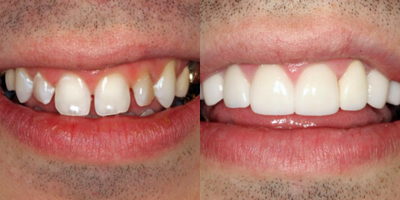 Dental Crown before and after photo