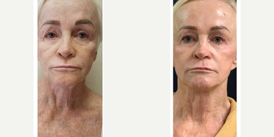 Fractora RF before and after photo
