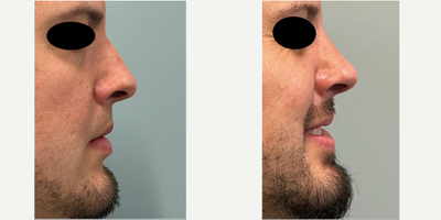 Revision Rhinoplasty before and after photo