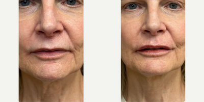 Botox before and after photo