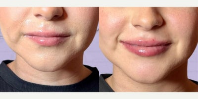 Dermal Fillers before and after photo