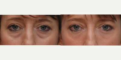 Eyelid Surgery before and after photo