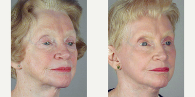 Facelift before and after photo