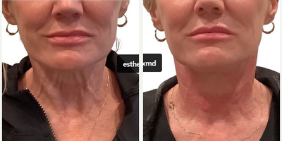Skin Rejuvenation before and after photo