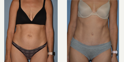 Tummy Tuck before and after photo