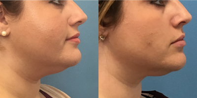 CoolSculpting before and after photo