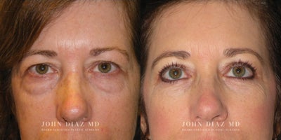 Eyelid Surgery before and after photo
