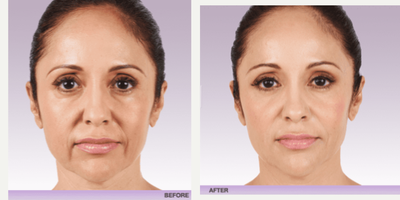 Juvederm before and after photo