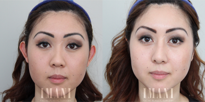 Ear Surgery before and after photo
