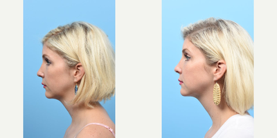 Eyelid Surgery before and after photo