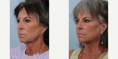 Facial Fat Transfer before and after photo
