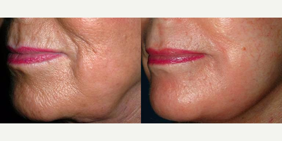 Fraxel Laser before and after photo