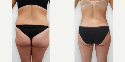 Laser Liposuction before and after photo