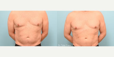Liposuction before and after photo