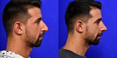 Revision Rhinoplasty before and after photo