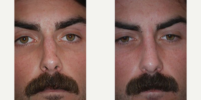 Rhinoplasty before and after photo