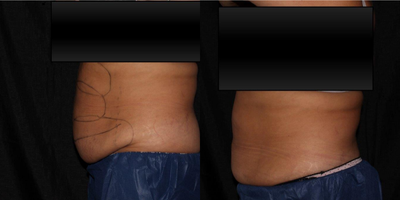 CoolSculpting before and after photo