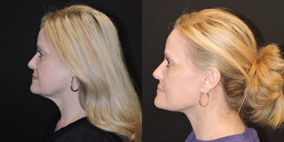 Deep Plane Facelift before and after photo
