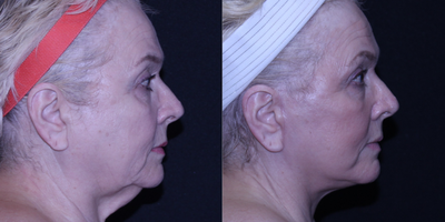 Facelift before and after photo