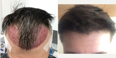 FUE Hair Transplant before and after photo